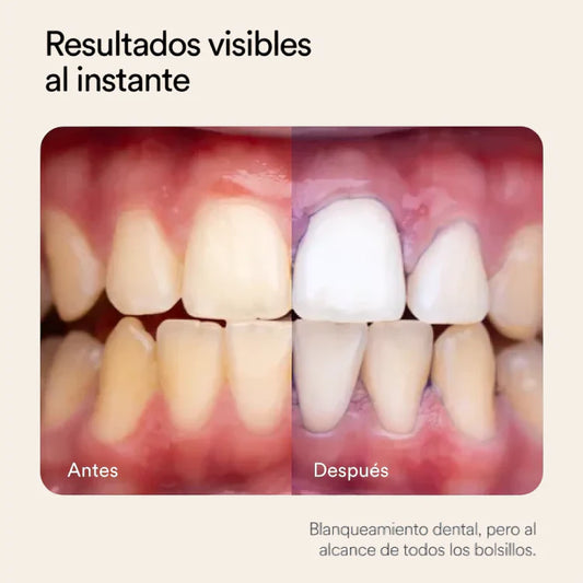Lumea blanqueador dental